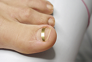 Nagelkorrekturspange-3