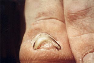 Nagelkorrekturspange-1a