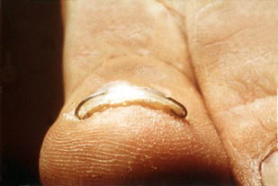 Nagelkorrekturspange-2a